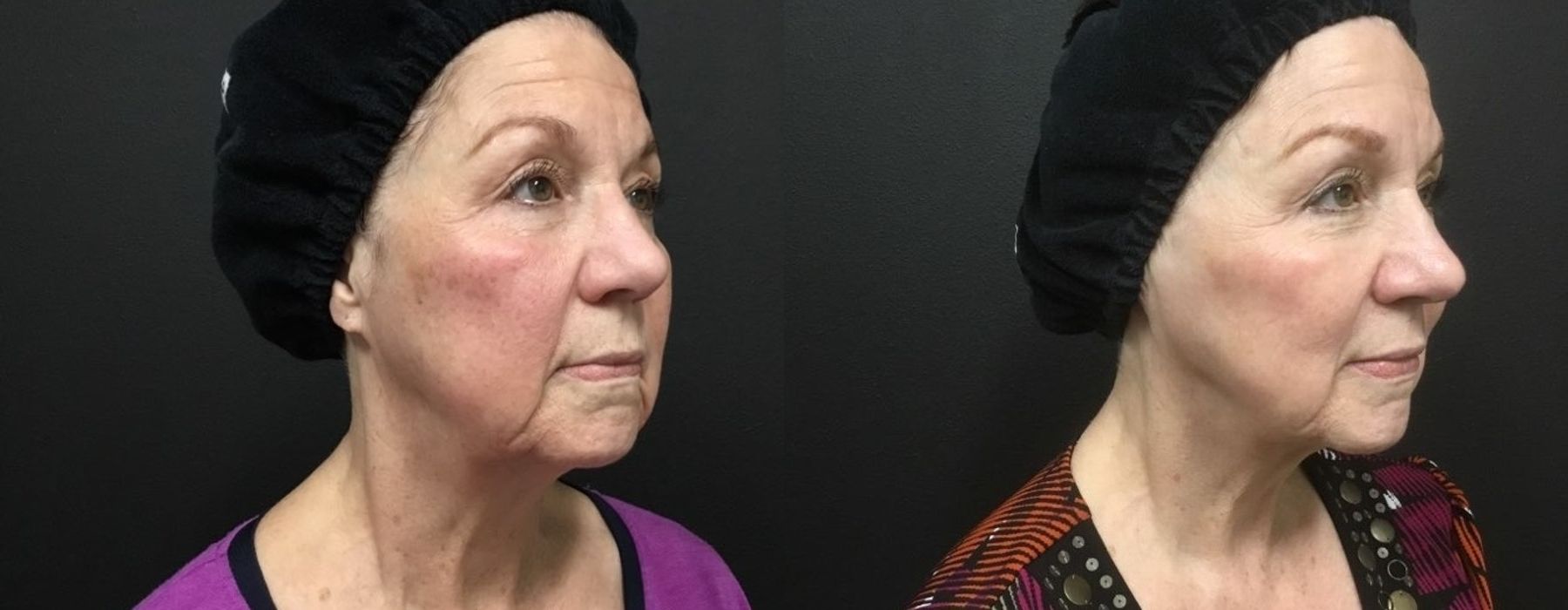 Laser - Pico Genesis - Thumbnail 3