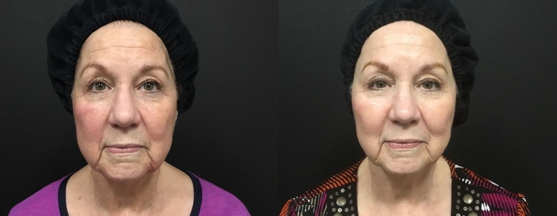 Laser - Pico Genesis - Thumbnail 2