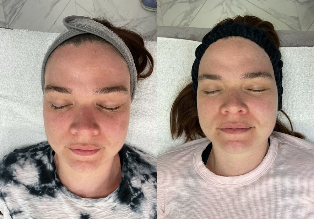 Laser - Pico Genesis - Thumbnail 3