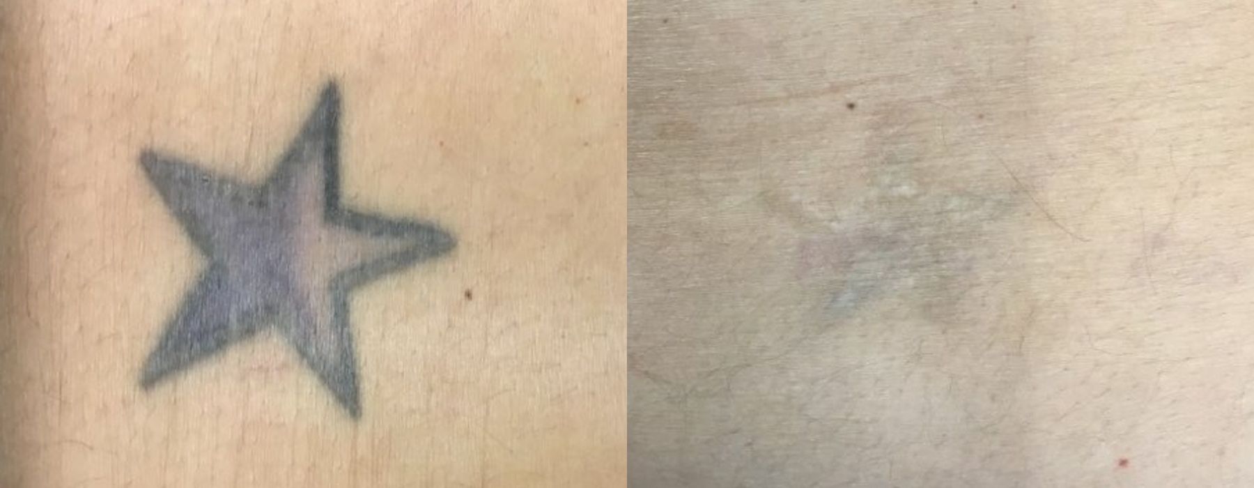 Laser Tattoo Removal - Case 5297