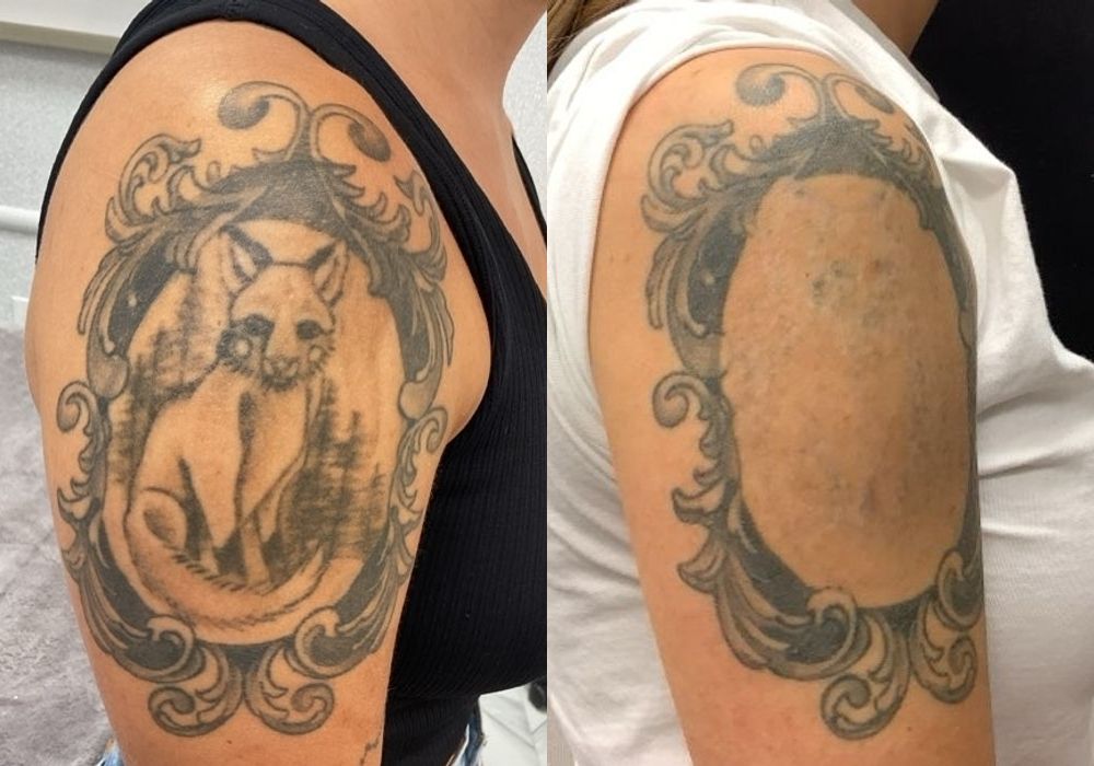 Laser Tattoo Removal - Case 5296