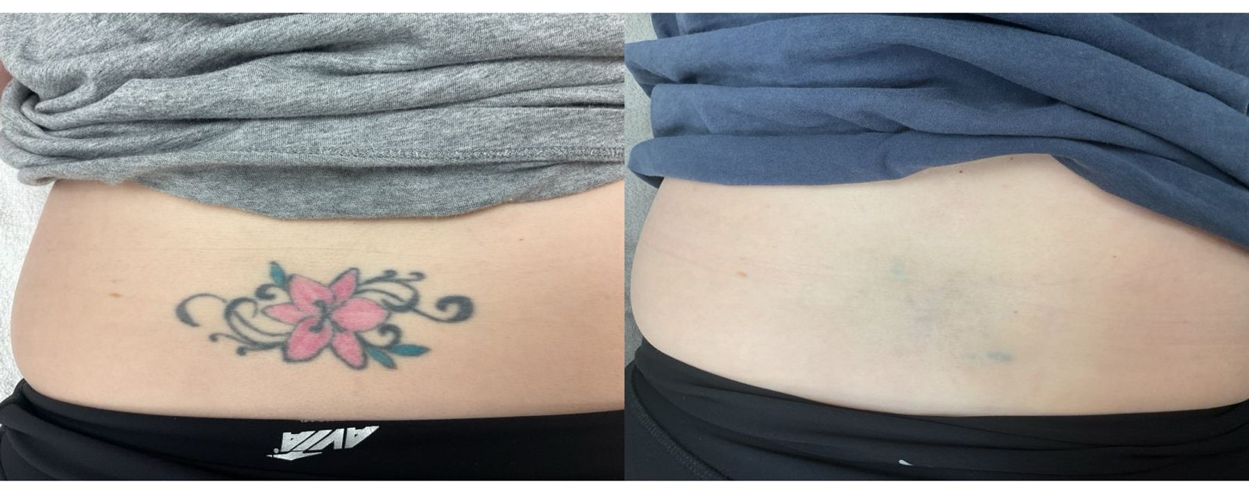 Laser tattoo removal before and after comparison of a lower back tattoo following 8 treatments and 6-month follow-up
