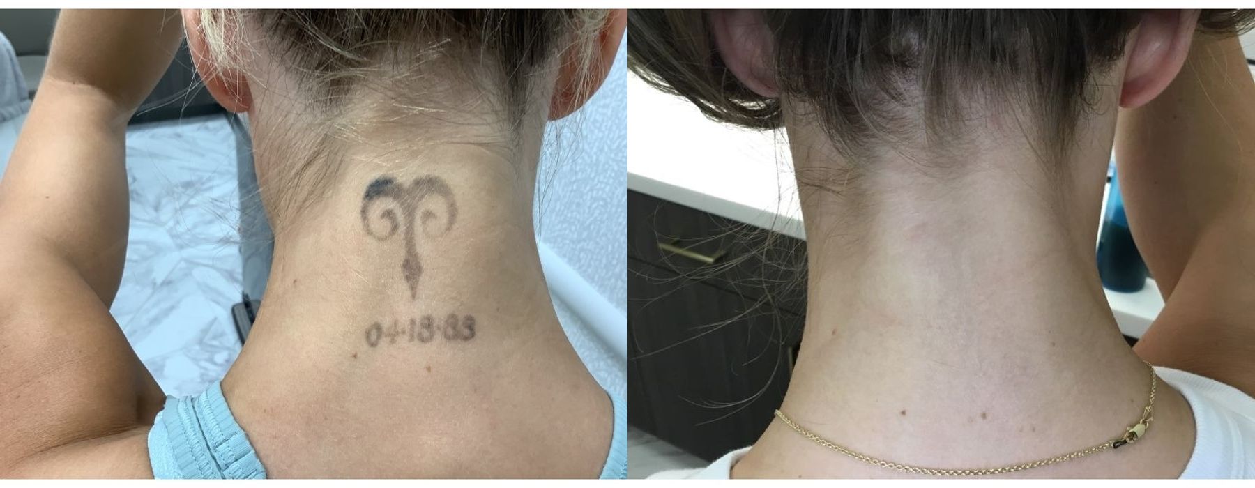 Laser Tattoo Removal - Case 5298