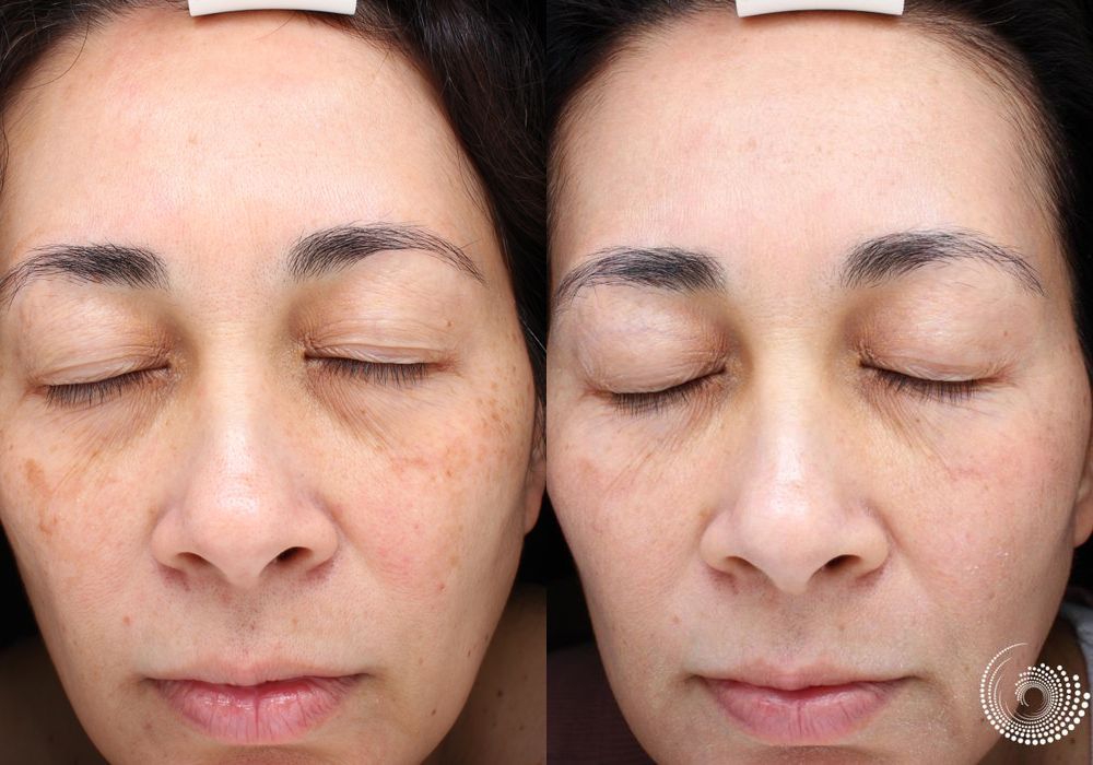 Laser - Ultra - Case 5323