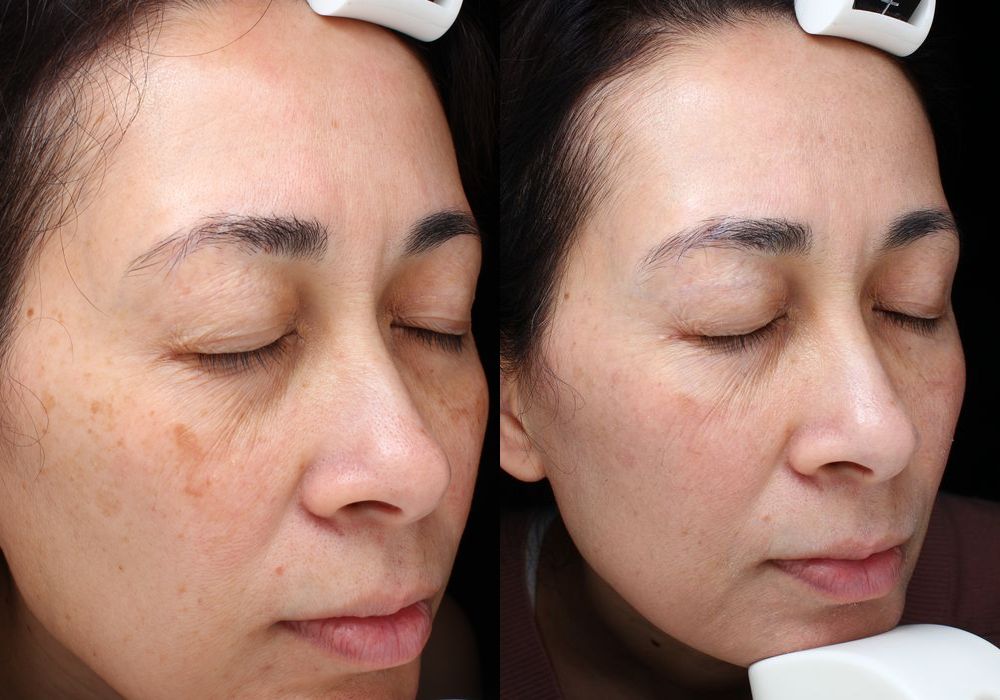 Laser - Ultra - Thumbnail 3