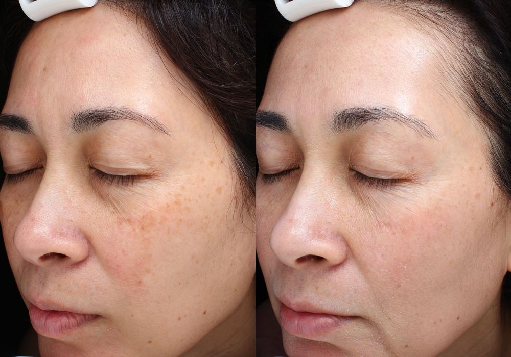 Laser - Ultra - Thumbnail 2