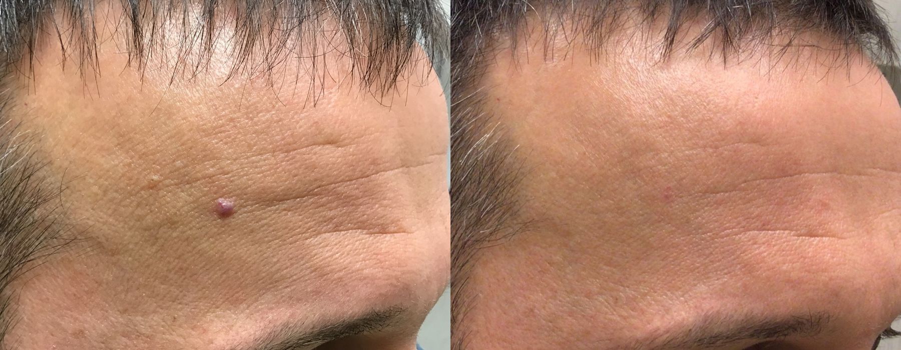 Laser - YAG - Case 5324