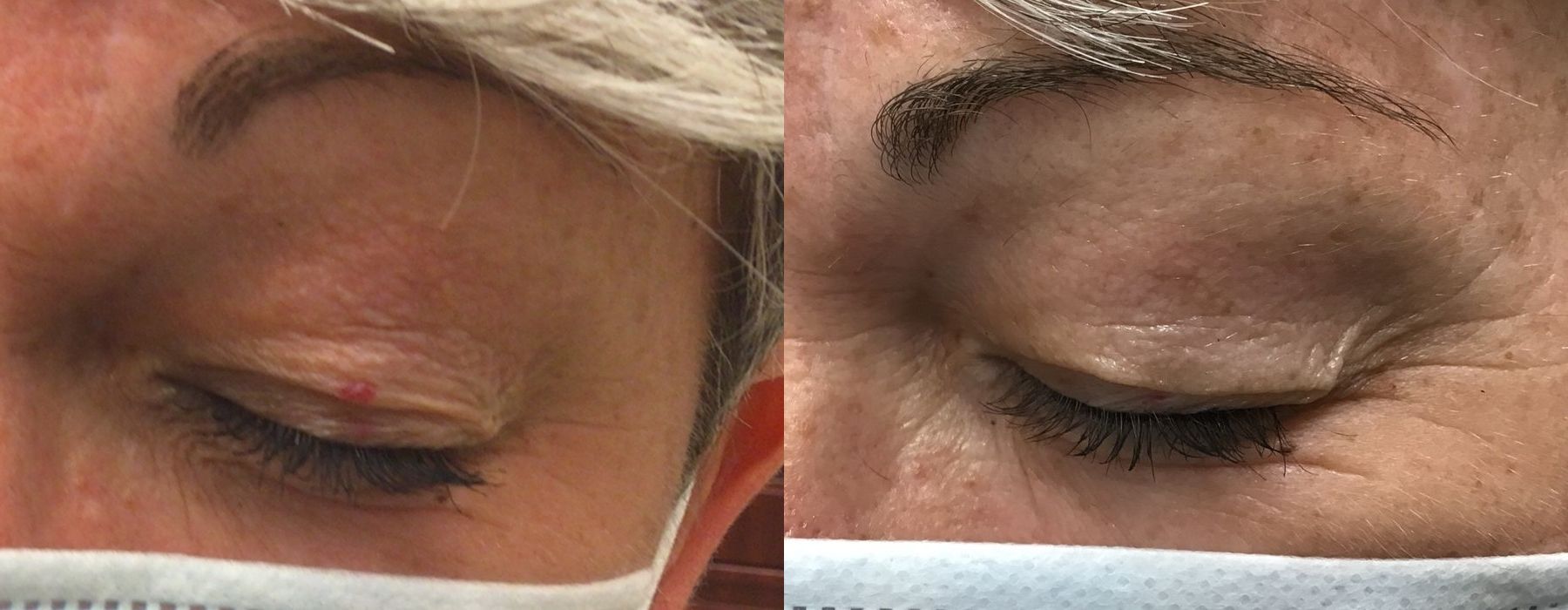 Laser - YAG - Case 5325