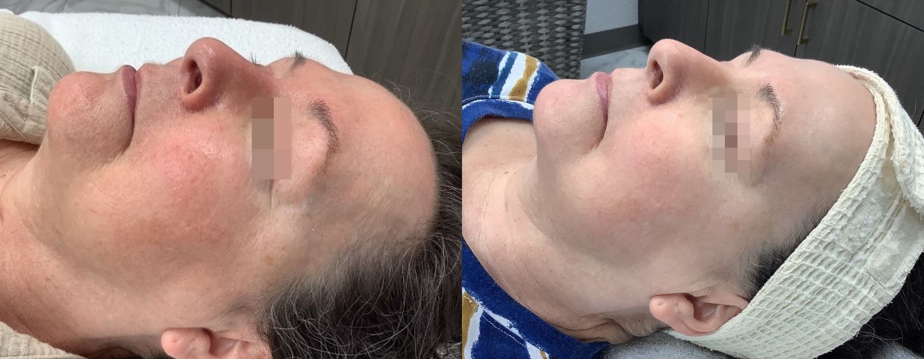 Limelight - Thumbnail 2