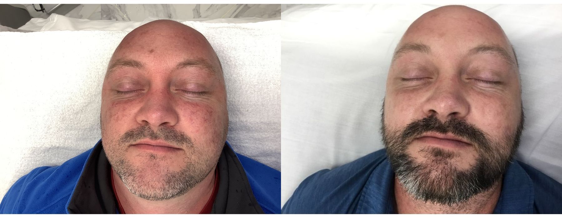 Limelight - Case 5332