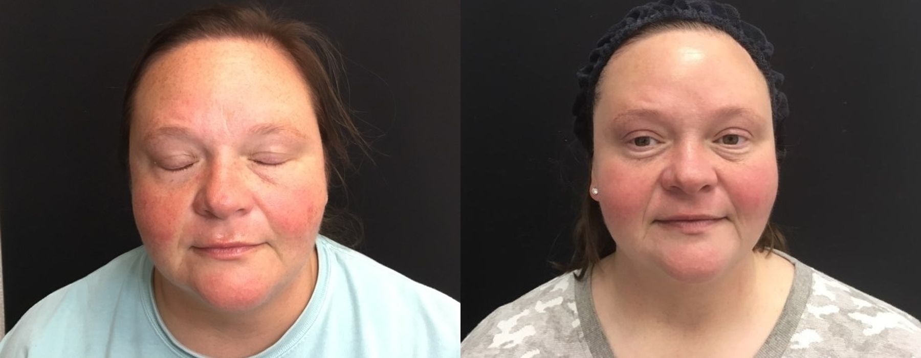 Limelight - Case 5334