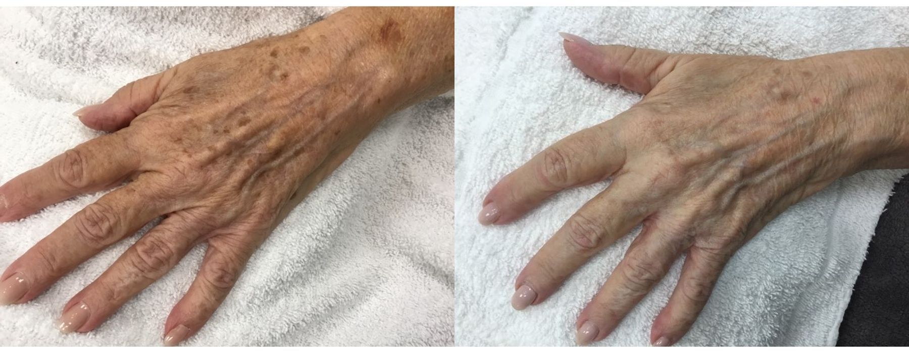 Limelight - Thumbnail 2