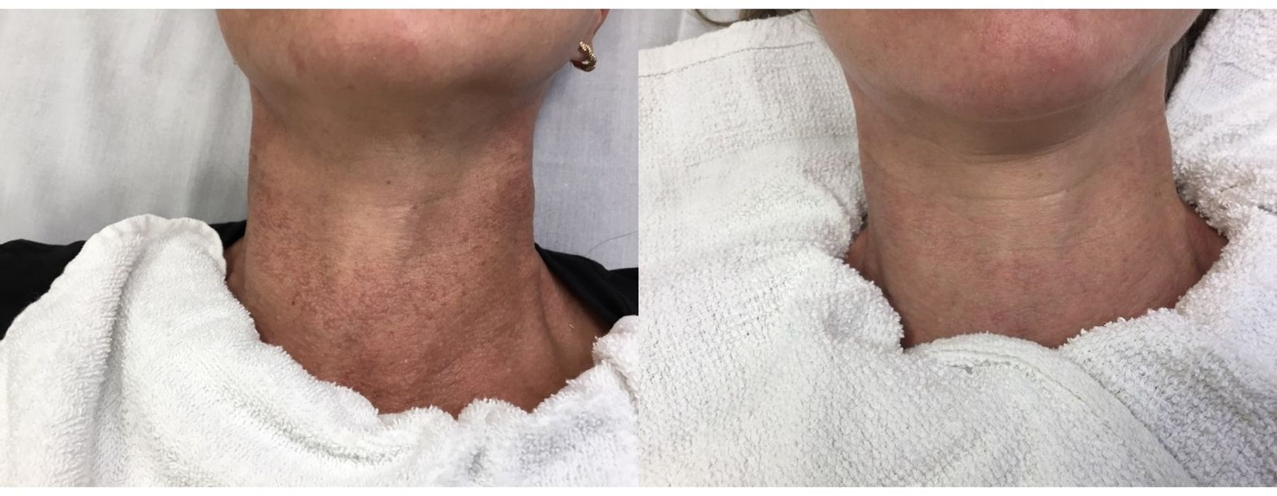 Limelight - Case 5333