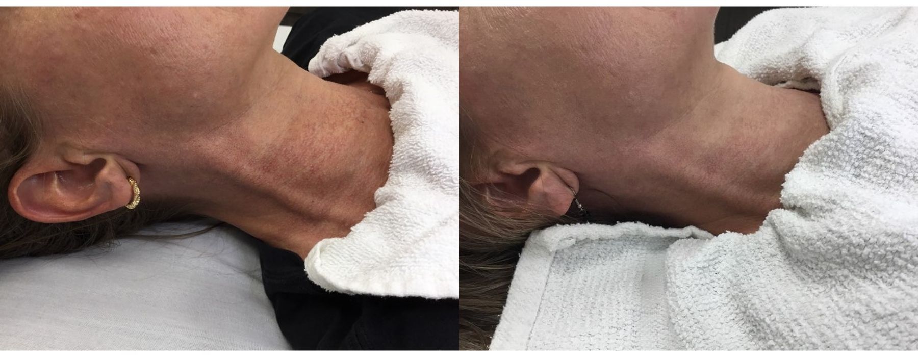 Limelight - Thumbnail 2