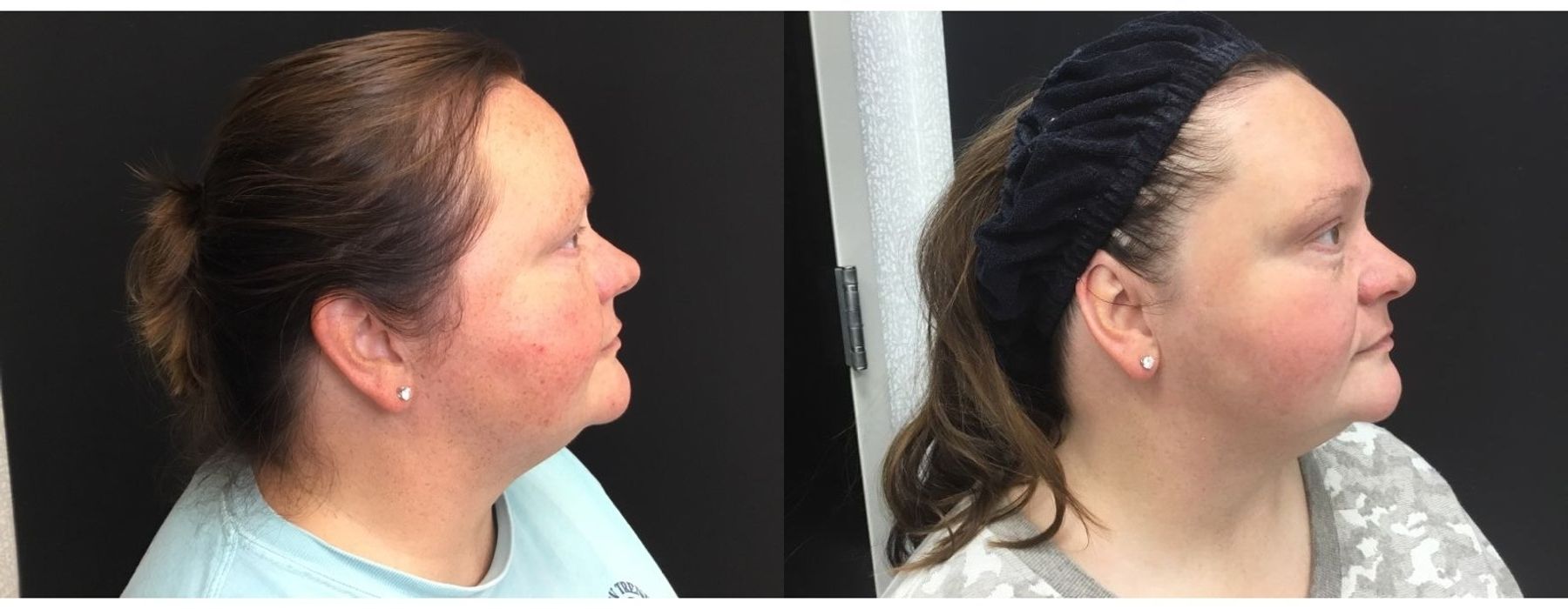 Limelight - Thumbnail 2