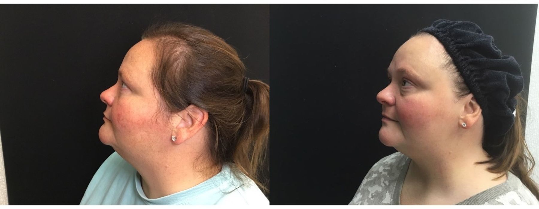 Limelight - Thumbnail 3