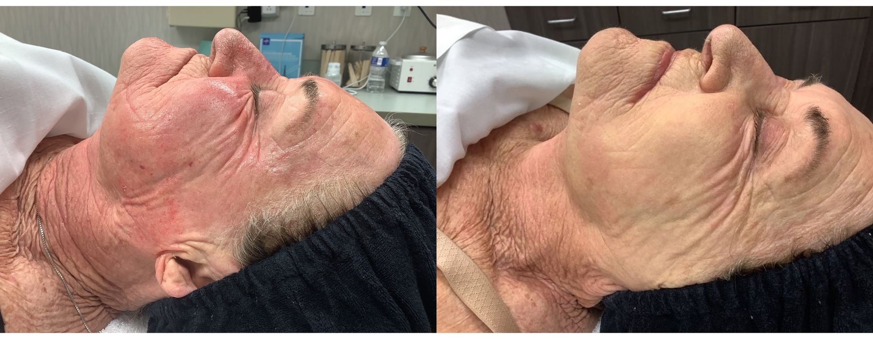 Limelight - Thumbnail 2