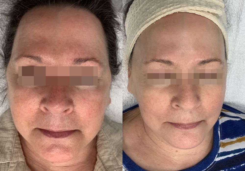 Limelight - Case 5330