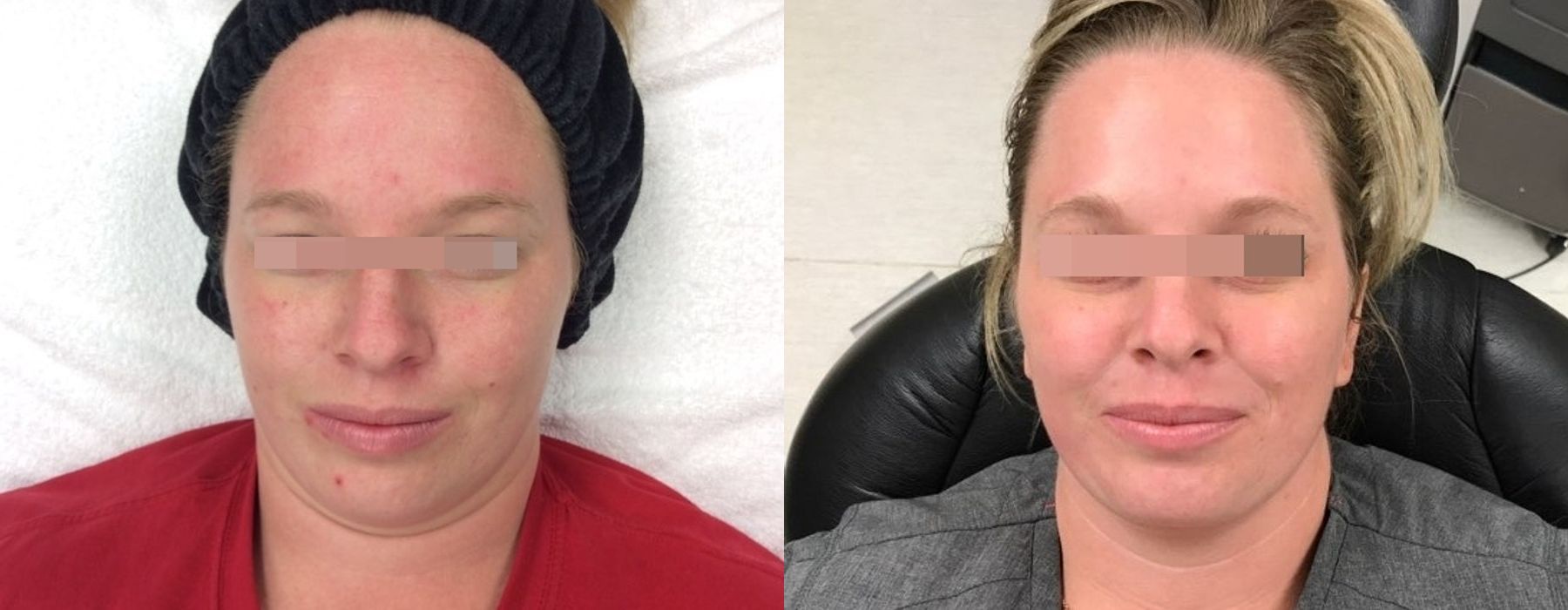 Limelight - Case 5327