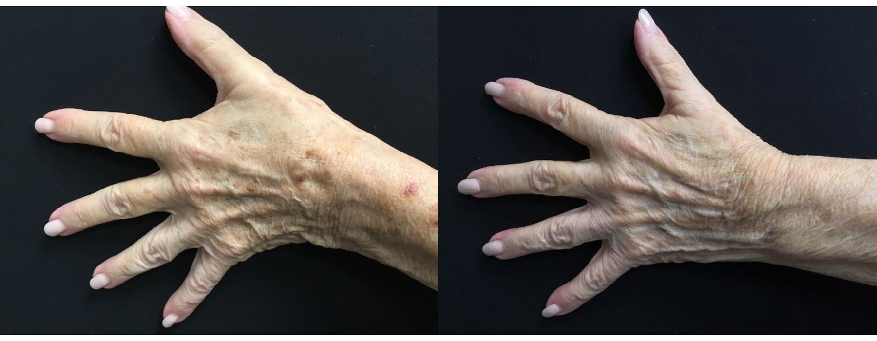 Limelight - Case 5331