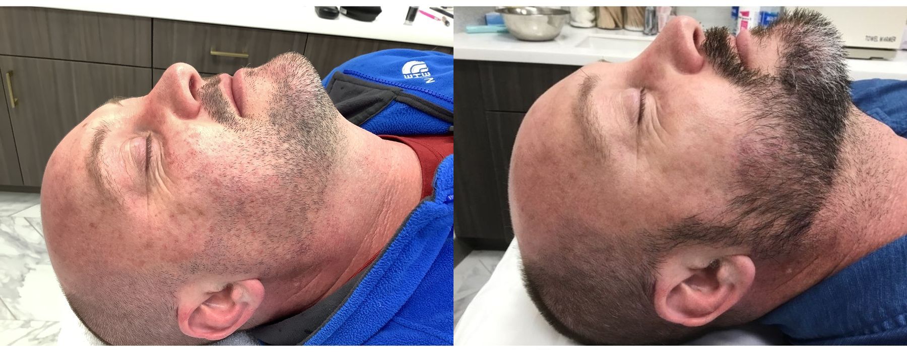 Limelight - Thumbnail 3