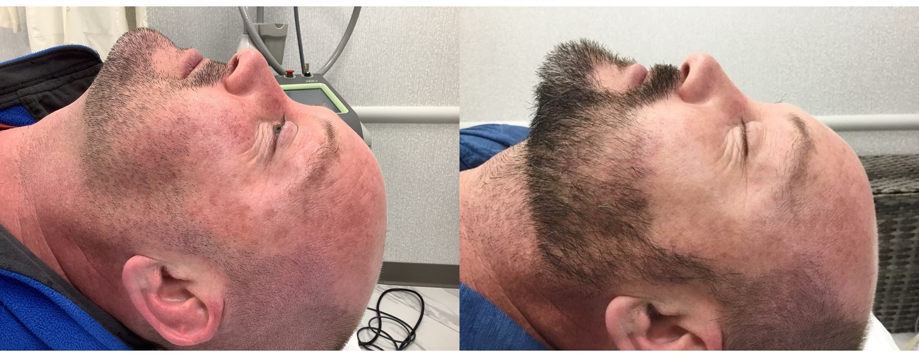 Limelight - Thumbnail 2