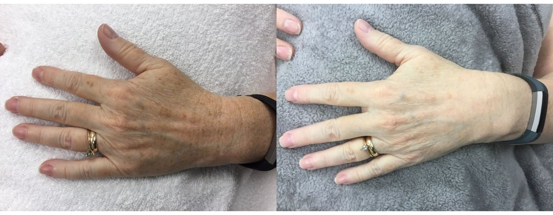 Limelight - Thumbnail 2