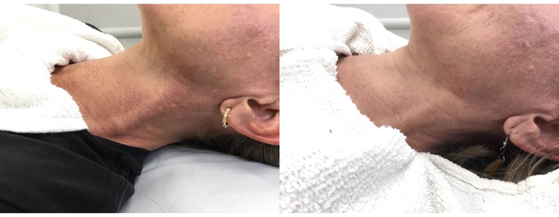 Limelight - Thumbnail 3