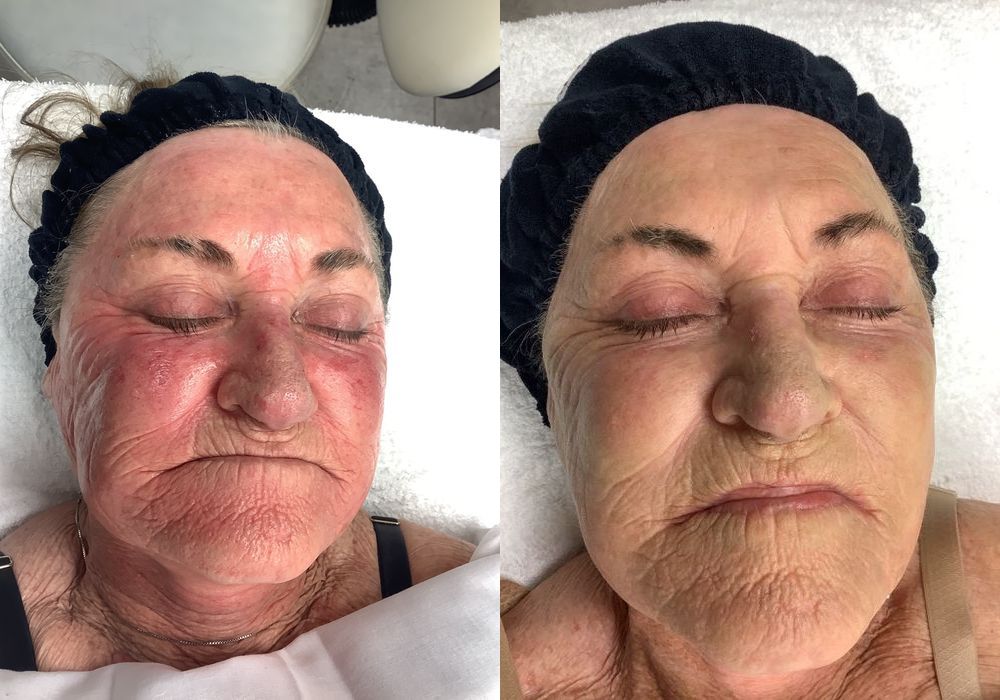 Limelight - Case 5335