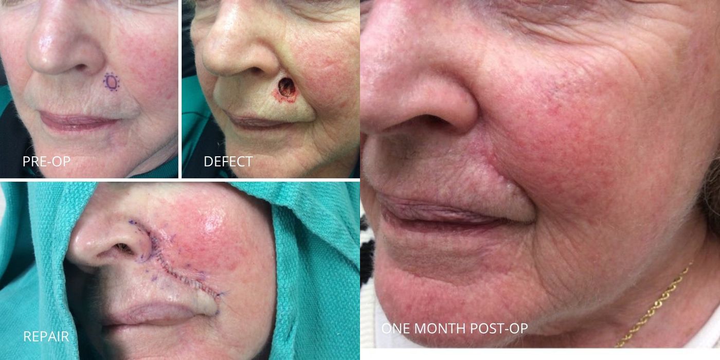 Mohs Surgery - Above Lip - Case 5365