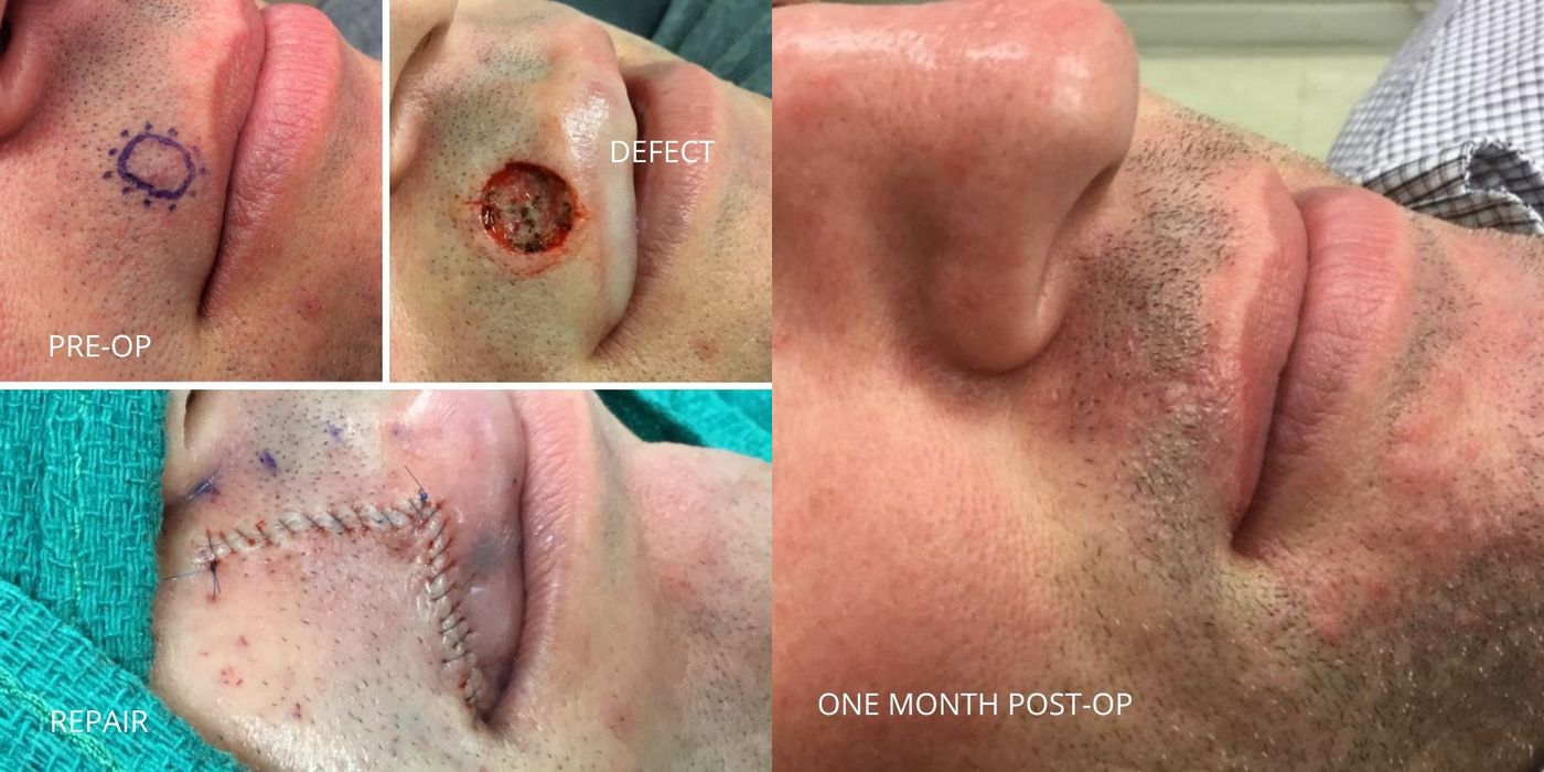Mohs Surgery - Above Lip - Case 5367