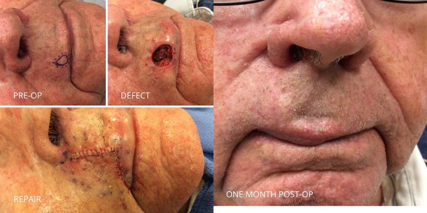 Mohs Surgery - Above Lip - Case 5366