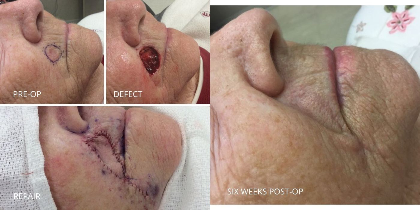 Mohs Surgery - Above Lip - Case 5364