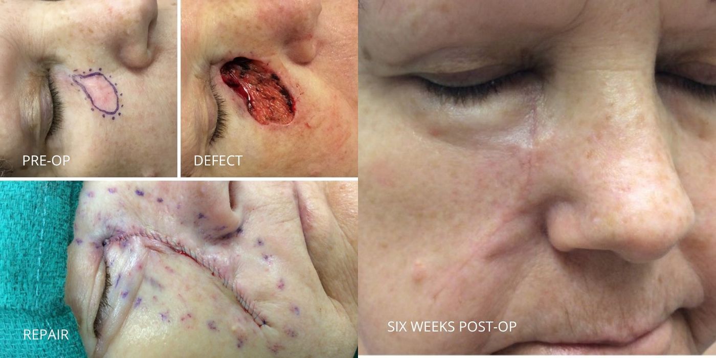 Mohs Surgery - Cheek - Case 5372