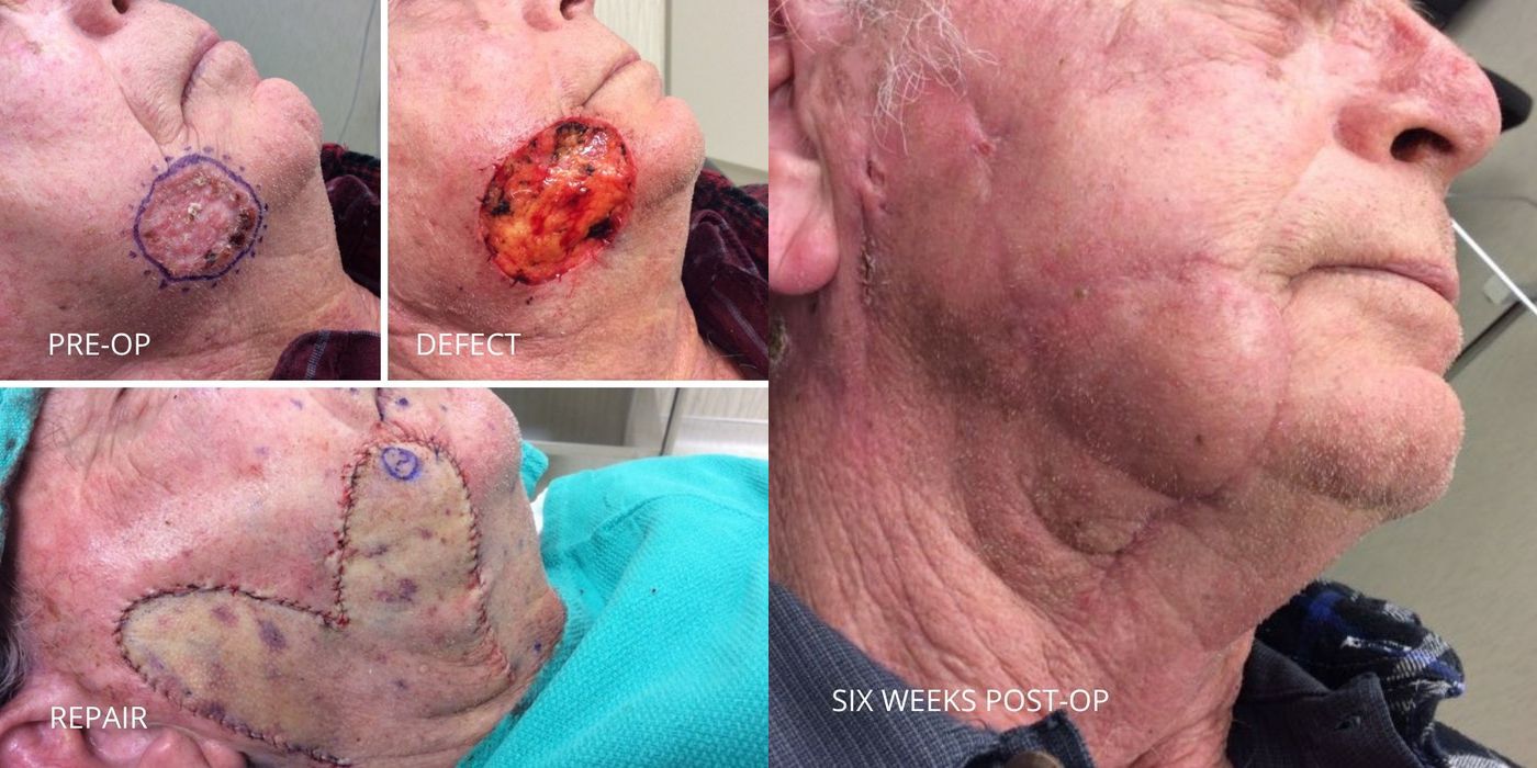 Mohs Surgery - Cheek - Case 5371