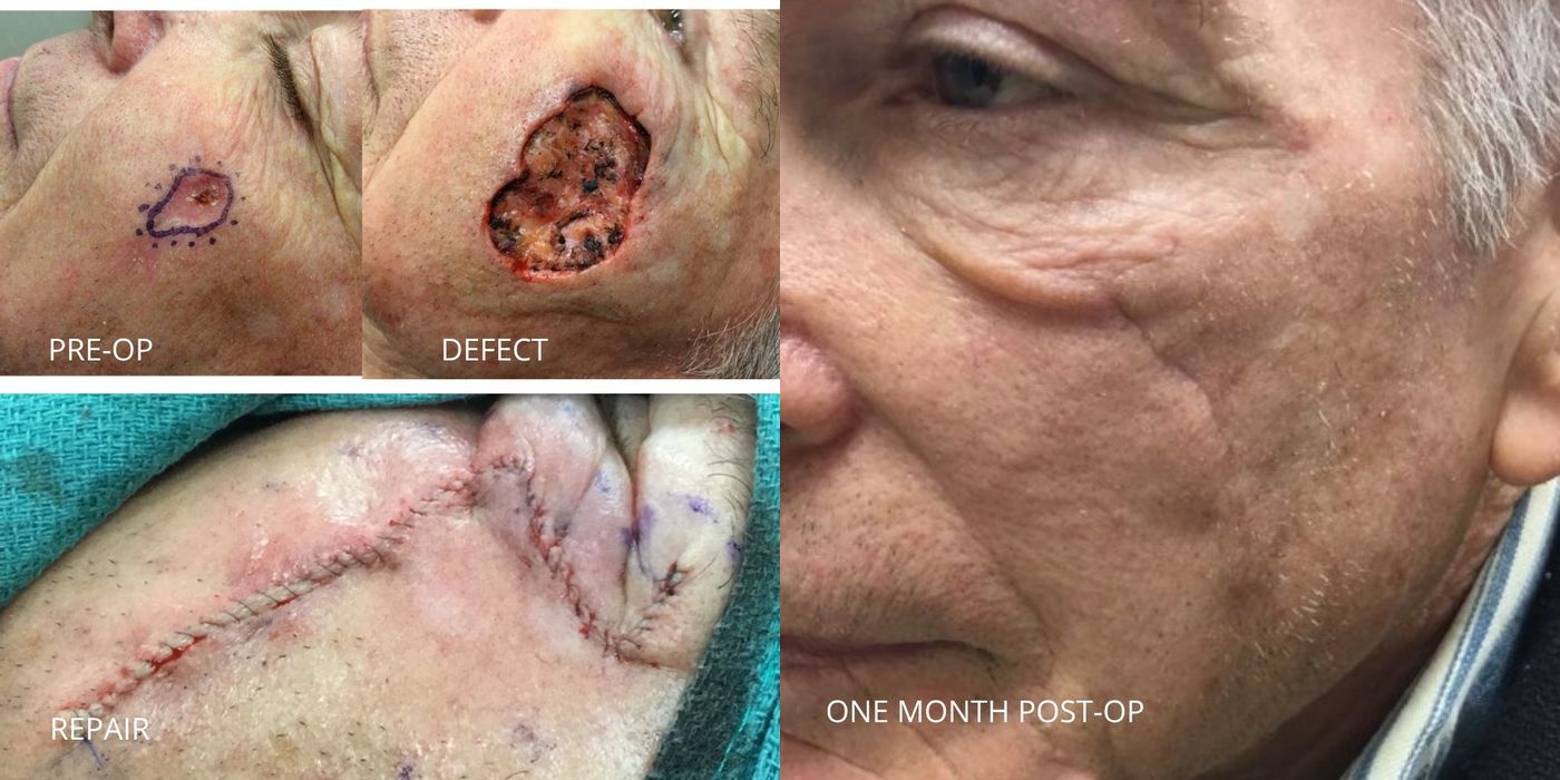 Mohs Surgery - Cheek - Case 5370