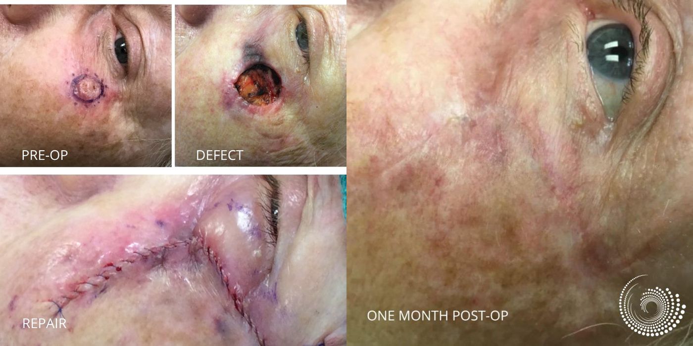 Mohs Surgery - Cheek - Case 5369