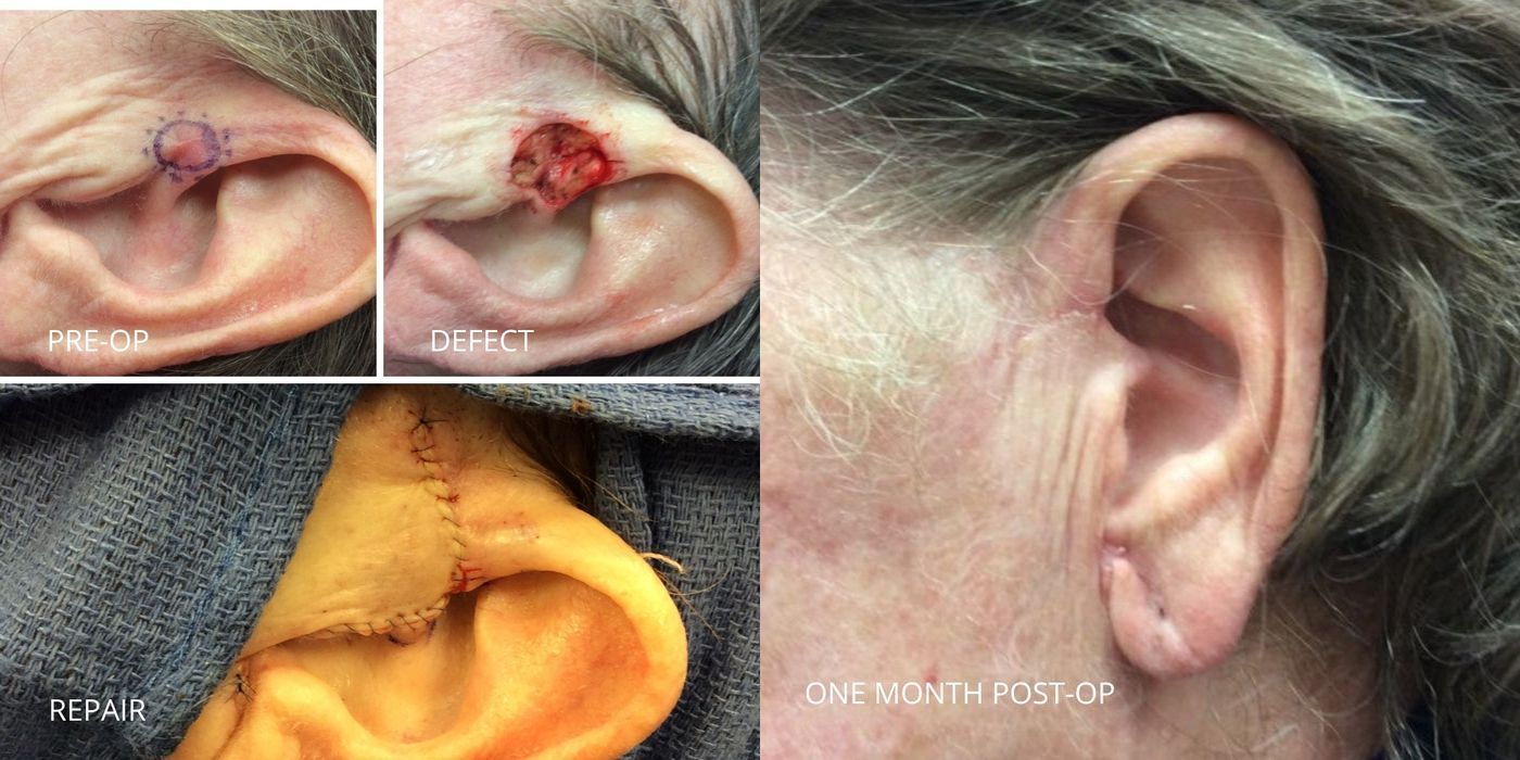 Mohs Surgery - Ear - Case 5376