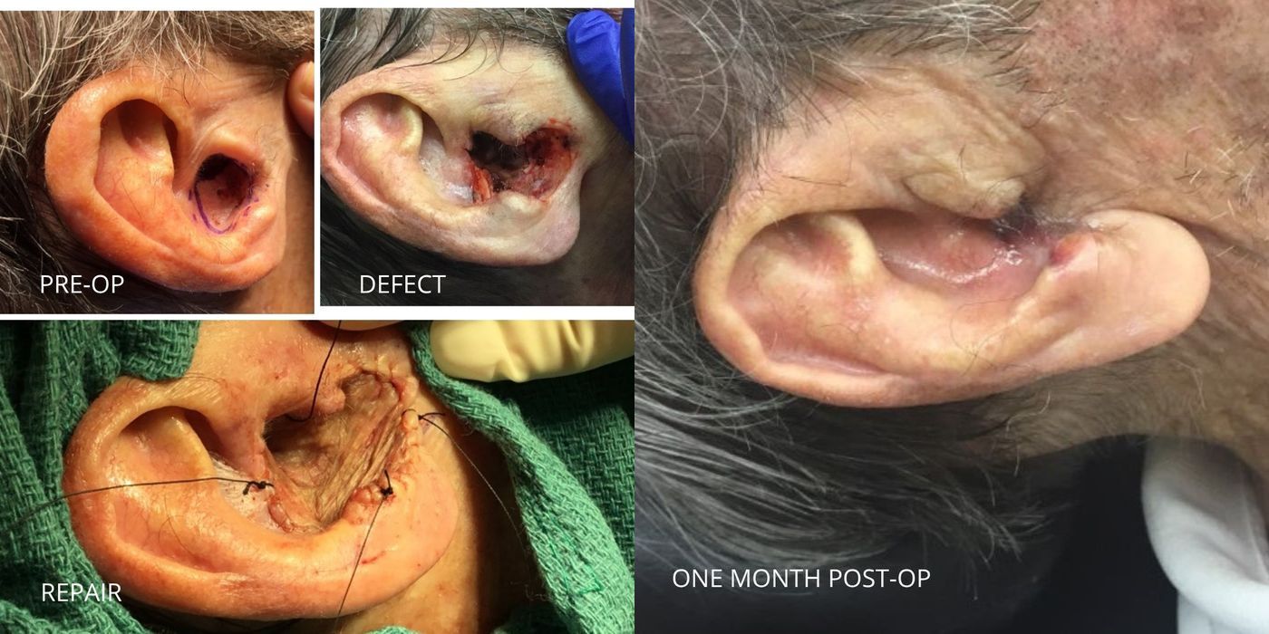 Mohs Surgery - Ear - Case 5375