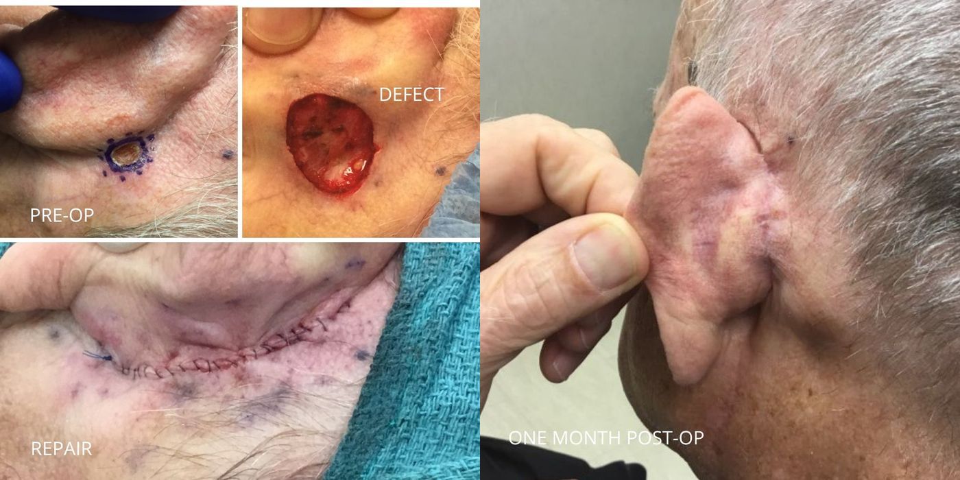 Mohs Surgery - Ear - Case 5378