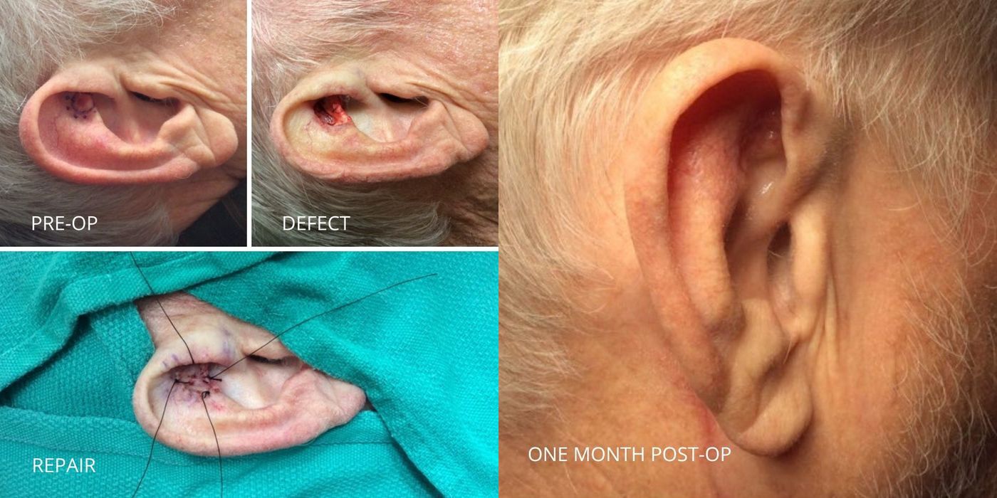 Mohs Surgery - Ear - Case 5377