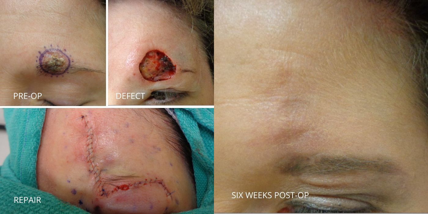 Mohs Surgery - Eyebrow - Case 5379