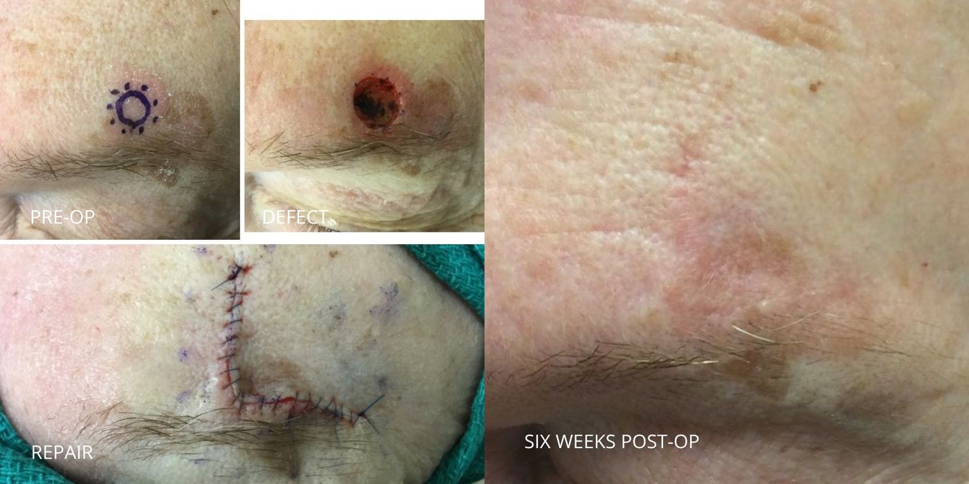 Mohs Surgery - Eyebrow - Case 5380