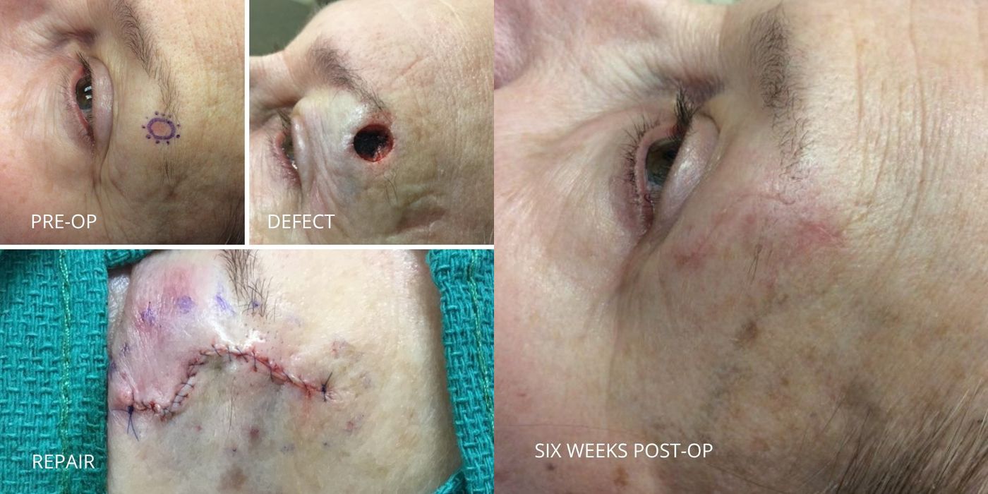 Mohs Surgery - Eyebrow - Case 5381