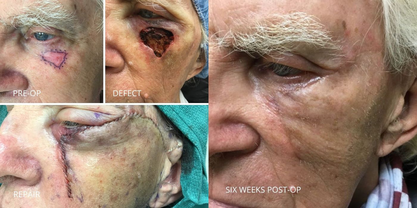 Mohs Surgery - Eyelid - Case 5382