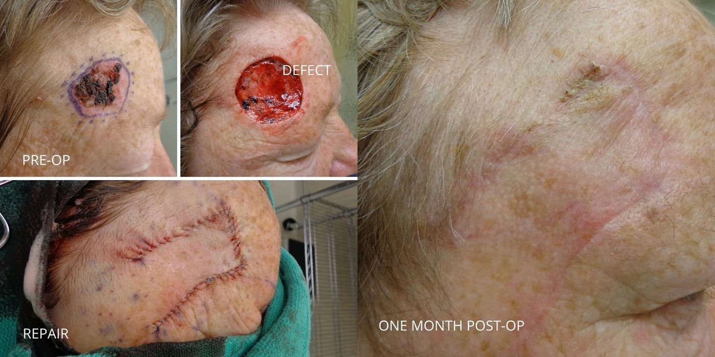 Mohs Surgery - Forehead - Case 5383