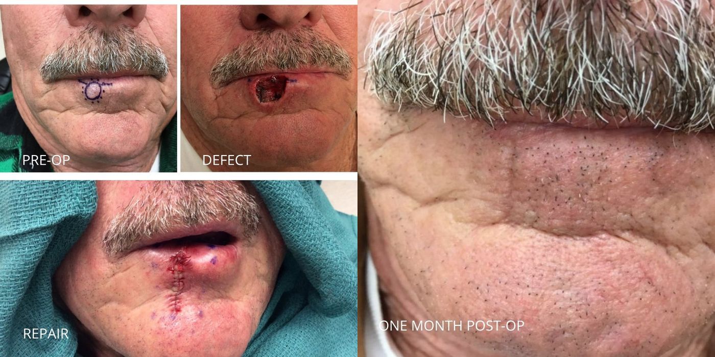 Mohs Surgery - Lip - Case 5386