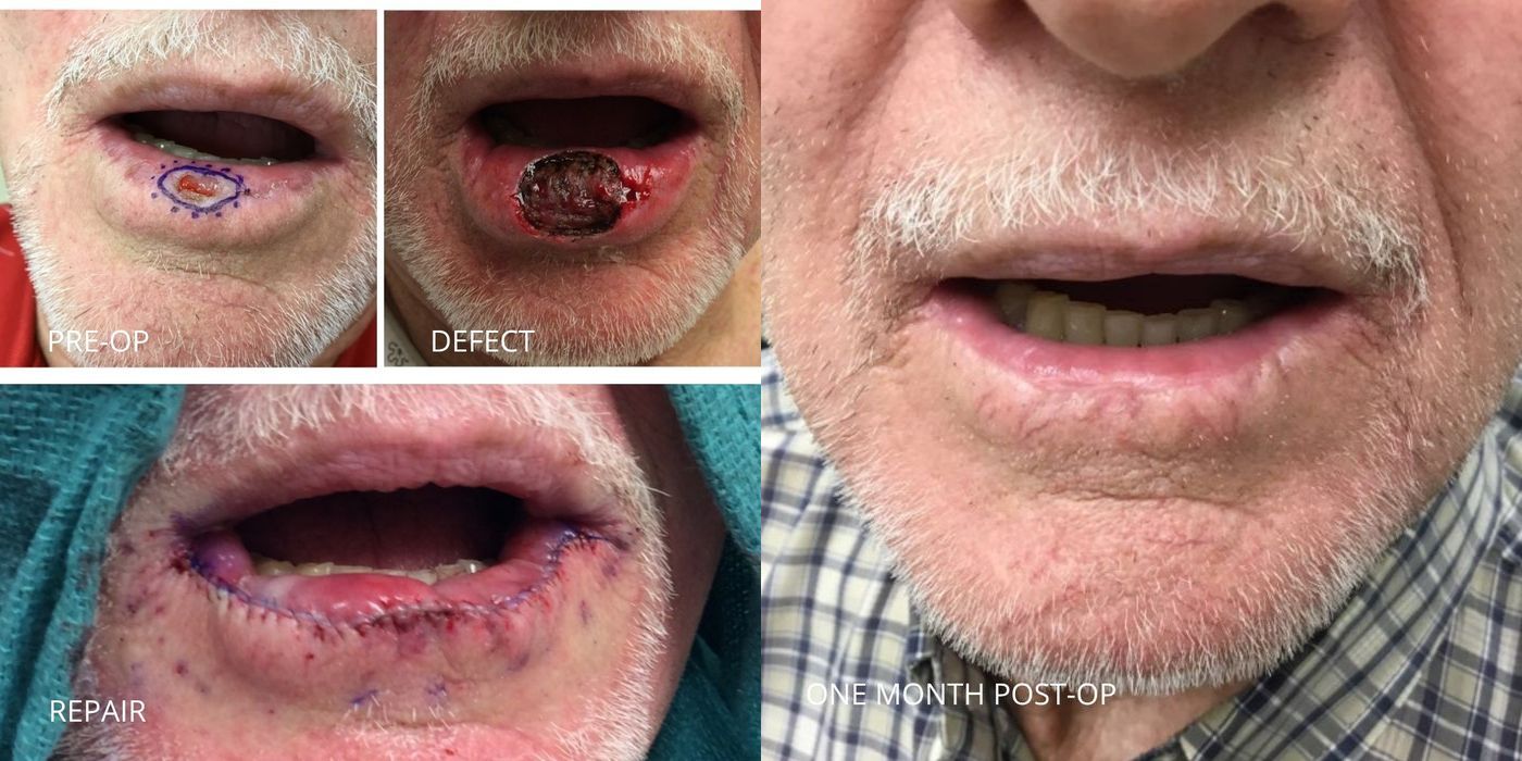 Mohs Surgery - Lip - Case 5385