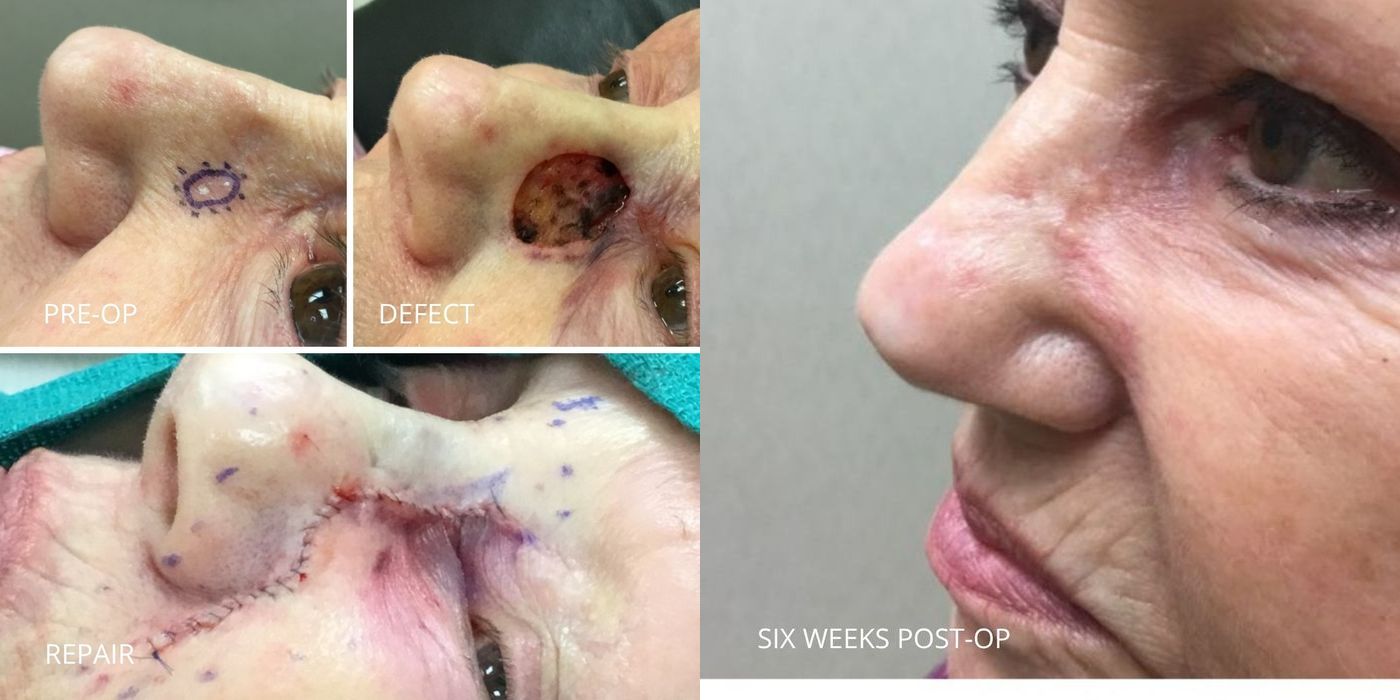 Mohs Surgery - Nose - Case 5402