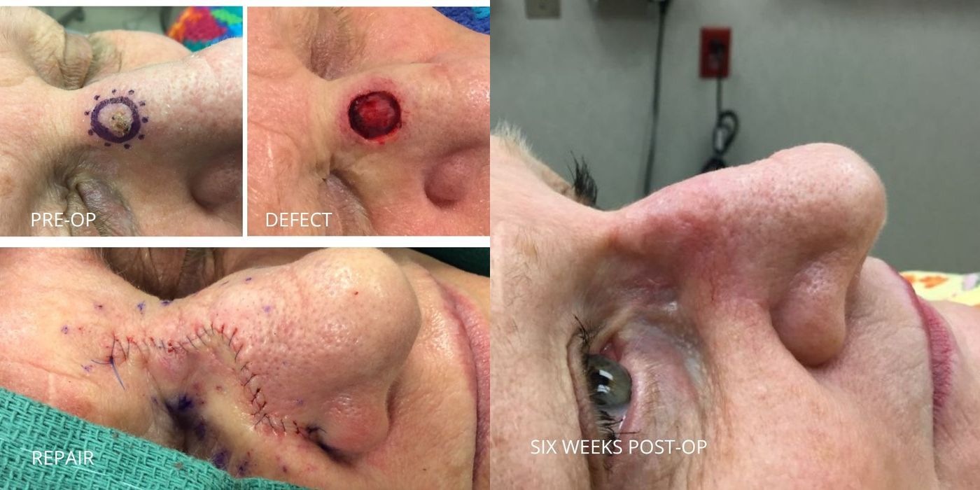 Mohs Surgery - Nose - Case 5400